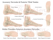 navicular poster