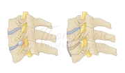 anterior cervical discectomy and fusion