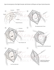 acromioplasty