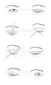 blepharoplasty