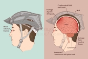 brain injury