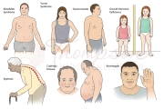 endocrine deformities