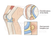 ganglion cyst