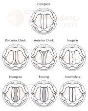 glottic closures