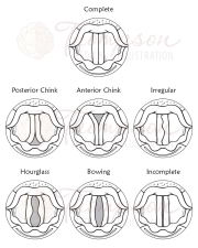 glottic closures