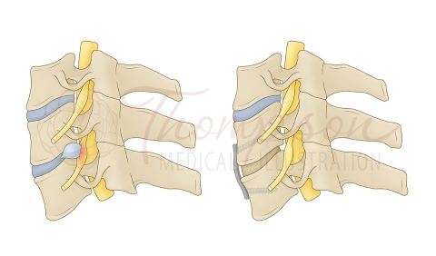 anterior cervical discectomy and fusion