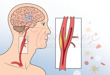 carotid artery disease