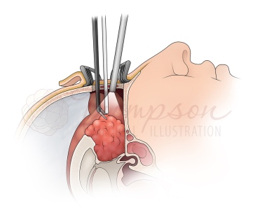 tumor removal