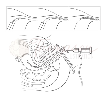 tubal sterilization