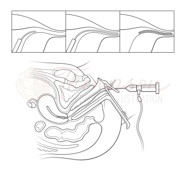 tubal sterilization