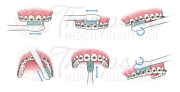 brushing braces