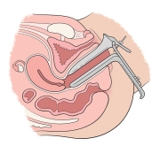 speculum